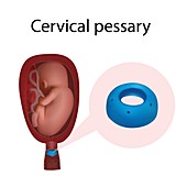 Cervical pessary, illustration