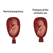 Amniotic sac prolapse and normal pregnancy, illustration