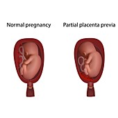 Partial placenta previa and normal pregnancy, illustration