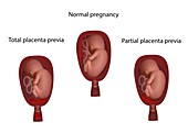 Health, partial and total placenta previa, illustration