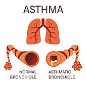Normal and asthmatic bronchioles, illustration