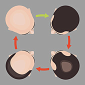 Hair loss stages in men, illustration