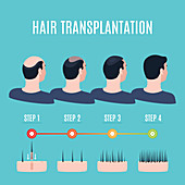 Hair transplantation surgery stages, illustration