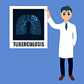 Tuberculosis diagnosis, illustration