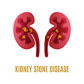Kidney stones, illustration