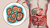 Hydatid disease in liver, alveolar echinococcosis, illustrat