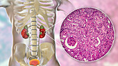 Chronic pyelonephritis, illustration and light micrograph