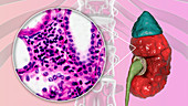 Chronic pyelonephritis, illustration and light micrograph