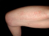 Allergic dermatitis from therapeutic tape on the thigh
