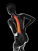Acute back pain, illustration