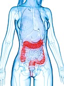 Diseased colon, illustration