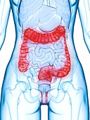 Diseased colon, illustration