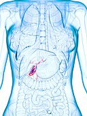 Diseased gallbladder, illustration