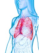 Diseased lung, illustration