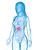 Diseased stomach, illustration