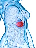 Diseased stomach, illustration