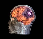 Recurrent glioma brain tumour, 3D MRI scan