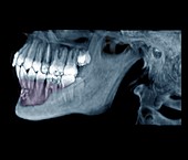 Jaw tumour, CT scan