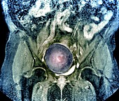 Uterine fibroid, MRI scan
