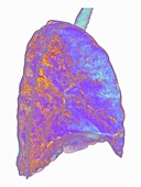 Lungs affected by Covid-19 atypical pneumonia, 3d CT scan