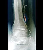 Narrowed leg artery, X-ray