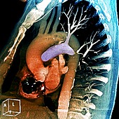 Aortic aneurysm stent, 3D CT scan