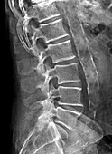 Atherosclerosis, X-ray