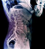 Healthy lower spine, X-ray