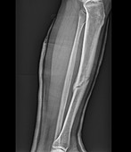 Healing fractured leg, X-ray