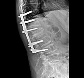 Treatment for osteoporosis of the spine, X-ray