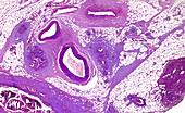 Benign breast tumour, light micrograph