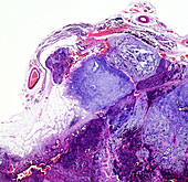 Pleomorphic adenoma of the parotid gland, light micrograph
