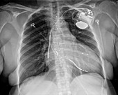 Pacemaker for heart failure, X-ray
