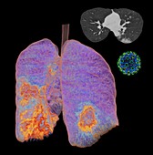 Lungs affected by Covid-19, CT scans and model