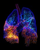 Lungs affected by Covid-19 atypical pneumonia, 3d CT scan