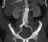 Aortic aneurysm stent, CT scan