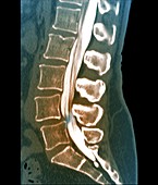 Herniated disc, CT scan