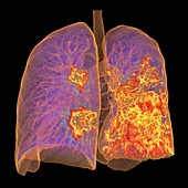 Lungs affected by Covid-19 atypical pneumonia, 3d CT scan