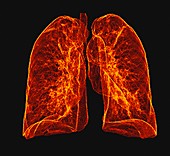 Healthy lungs, CT scan