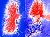 Pulmonary embolism and healthy lung, angiograms