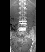 Intervertebral disc implants, X-ray