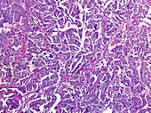 Human ovarian cancer, light micrograph