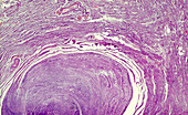 Human uterine fibroid, light micrograph
