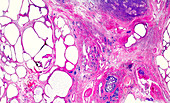 Human prostate cancer, light micrograph