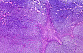 Human testicular seminoma, light micrograph
