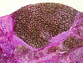 Malignant melanoma of the human liver, light micrograph