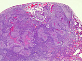Caseous necrosis of the lymphatic node, light micrograph