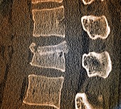 Fractured lumbar vertebra, CT scan