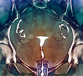Healthy female reproductive system, X-ray