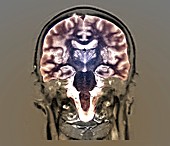 Cerebral atrophy, MRI scan